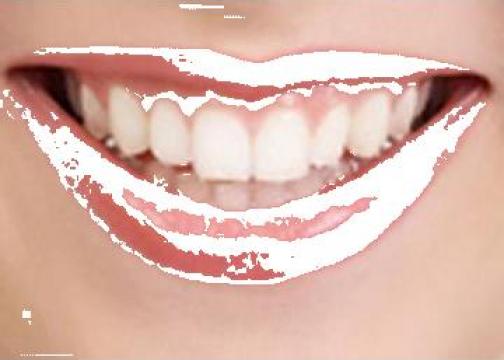 Cosmetica dentara - albirea dintilor