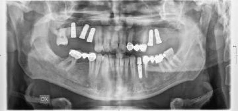 Implant dentar de la Cmi Hleihil Mahmod