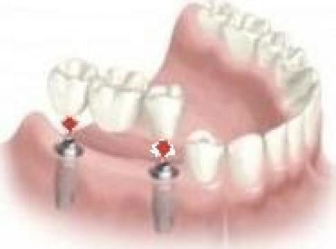 Implant dentar, coroana dentara pe implant