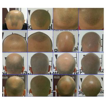 Tricopigmentare micropigmentare scalp